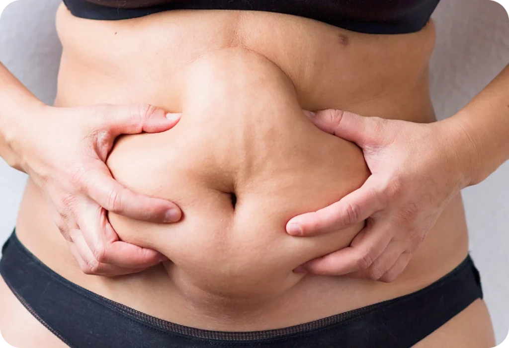 peau relachee ventre perte poids peau relachee ventre perte poids Raffermir sa peau après une perte de poids PRISME – Maison de soins esthétiques